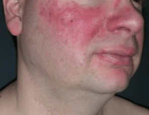 Acne Rosacea A Chronic Skin Disease
